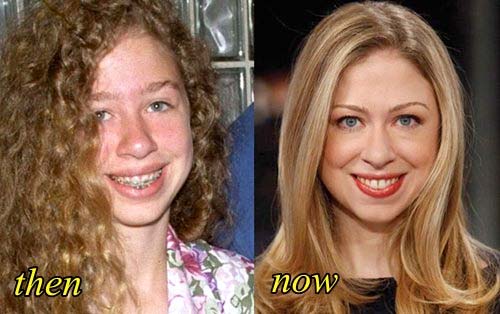 adjacent inages comparing Chelsea Clinton's features before and after plastic surgery